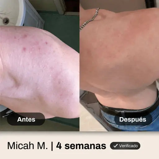 Shield Body Acne