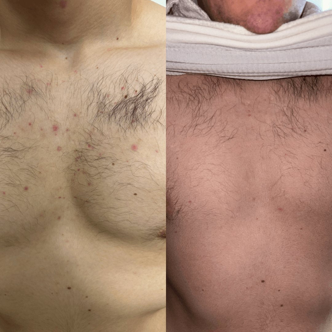 Resultados de antes y después