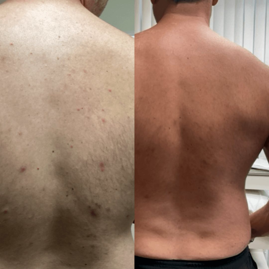 Resultados de antes y después